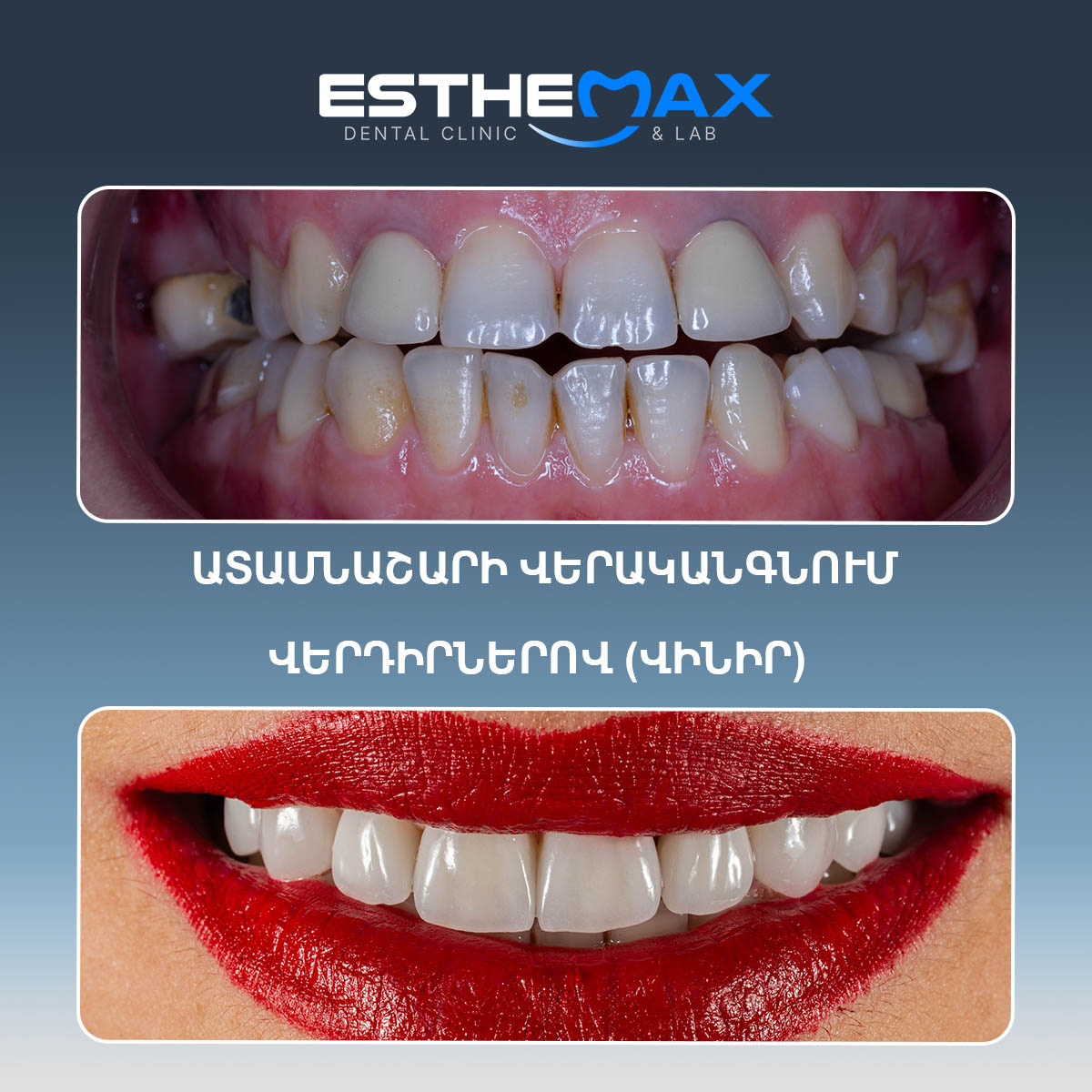 Veneer restoration - before and after